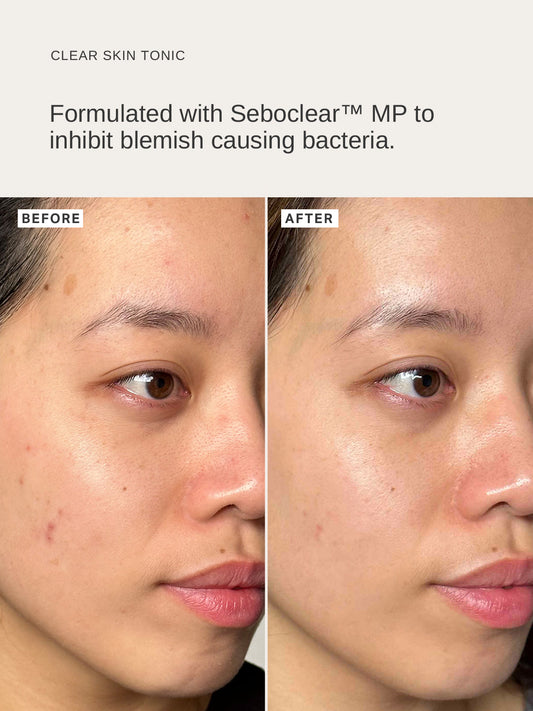 The Alpha-H Clear Skin Tonic is a BHA exfoliating treatment for normal to oily skin designed to decongest pores, control excess oil and minimise bacteria that leads to breakouts.
Powered by 2% salicylic acid, Seboclear MP, Arnica flower, Thyme, Tea Tree and Eucalyptus this magic tonic gently exfoliates and increases skin renewal, with a pH of 3.6 - 4.0 to help decongest and clear pores of debris and excess oil.