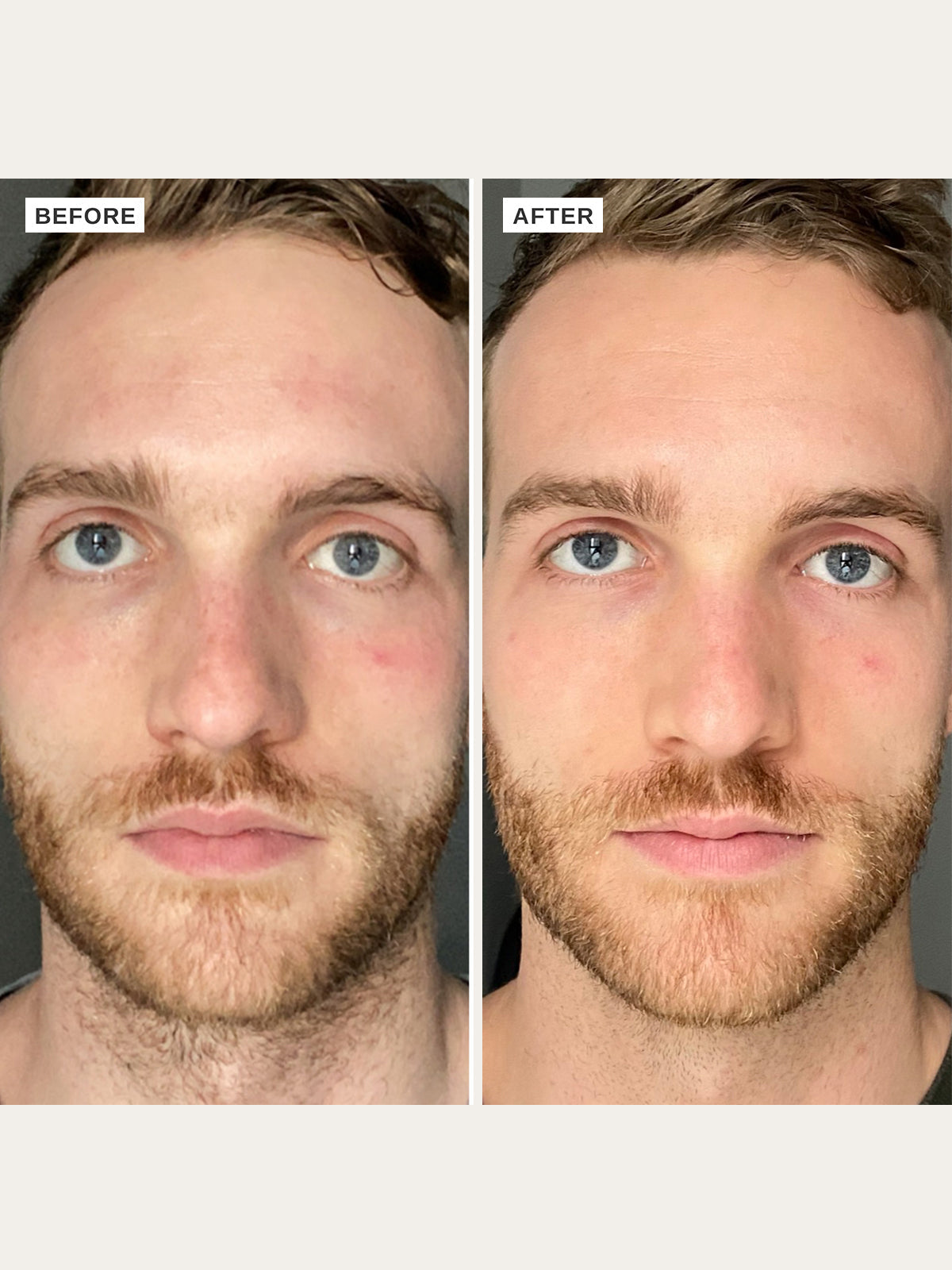 The Alpha-H Vitamin B Serum with 5% Niacinamide is a deeply hydrating serum designed to protect against free radical damage, hydrate and even tone, whilst supporting the skin’s natural barrier function.
Enriched with 5% niacinamide, chia seed, hyaluronic acid and Blue Gardenia extract, this serum is the all-in-one power hitter your skin needs for hydration, fine lines and wrinkles, balancing oils and evening and brightening your skin tone!