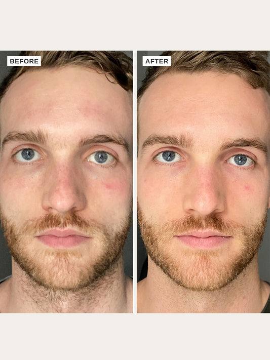 The Alpha-H Vitamin B Serum with 5% Niacinamide is a deeply hydrating serum designed to protect against free radical damage, hydrate and even tone, whilst supporting the skin’s natural barrier function.
Enriched with 5% niacinamide, chia seed, hyaluronic acid and Blue Gardenia extract, this serum is the all-in-one power hitter your skin needs for hydration, fine lines and wrinkles, balancing oils and evening and brightening your skin tone!