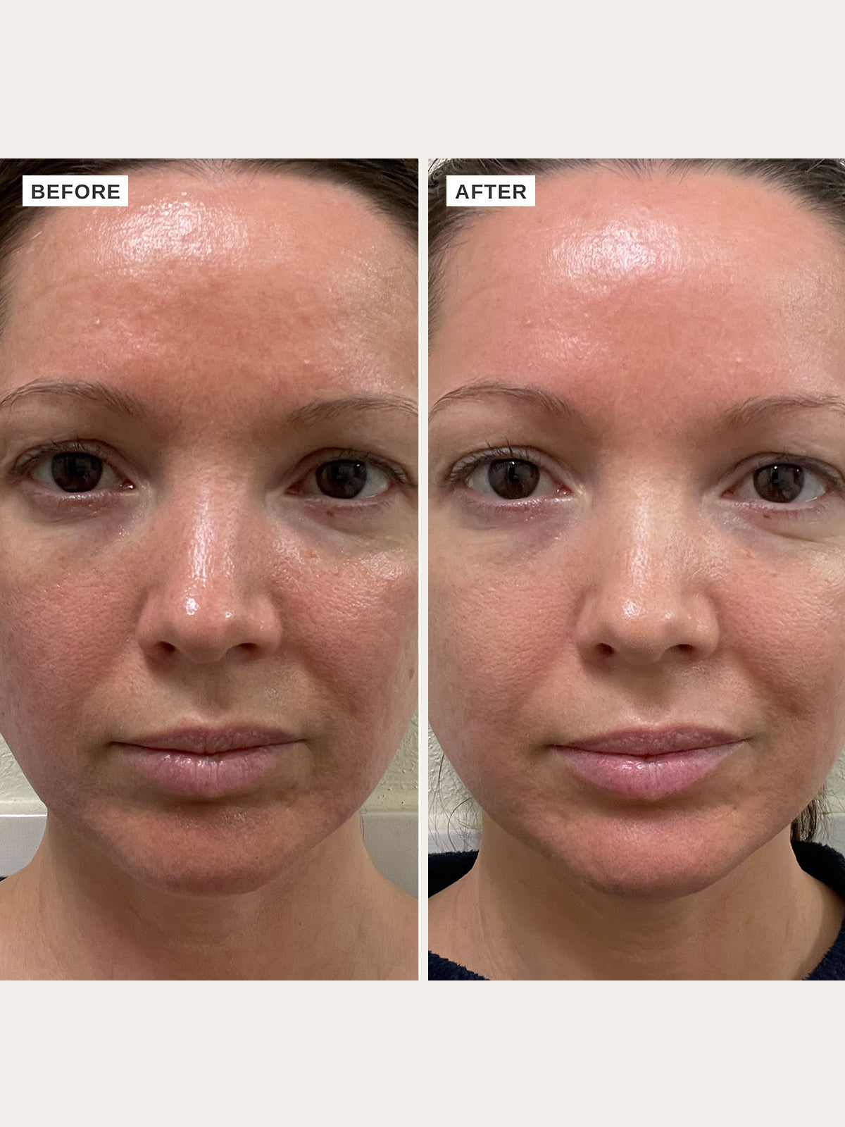 The Alpha-H Vitamin B Serum with 5% Niacinamide is a deeply hydrating serum designed to protect against free radical damage, hydrate and even tone, whilst supporting the skin’s natural barrier function.
Enriched with 5% niacinamide, chia seed, hyaluronic acid and Blue Gardenia extract, this serum is the all-in-one power hitter your skin needs for hydration, fine lines and wrinkles, balancing oils and evening and brightening your skin tone!