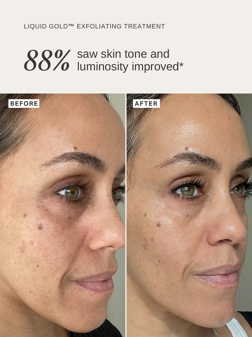 Alpha-H Liquid Gold 100ml exfoliating solution for acne, wrinkles, hyperpigmentation, improved skin tone and texture